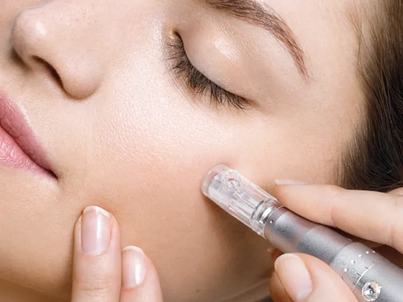 Microneedling procedure