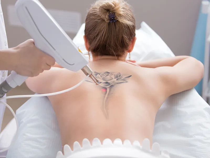 Tattoo Removal procedure